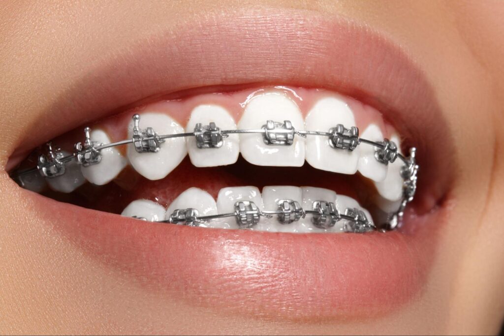 Choosing Between Metal & Clear Braces