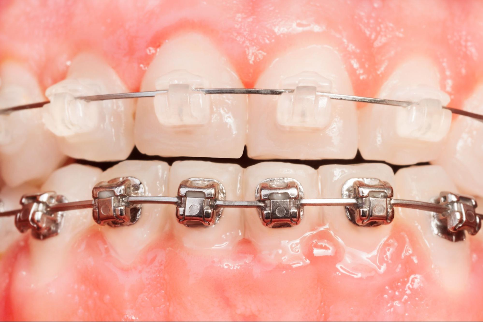 Choosing Between Metal & Clear Braces